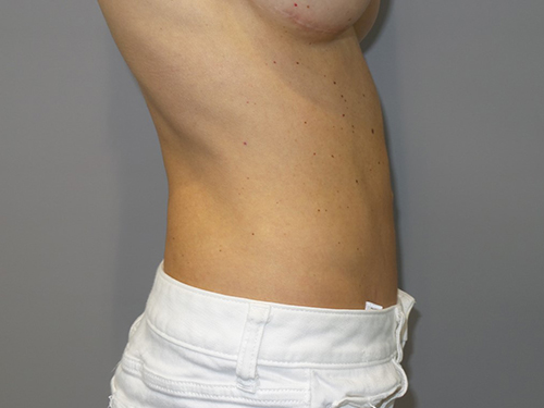 Tummy Tuck Before and After 99 | Grover Aesthetics