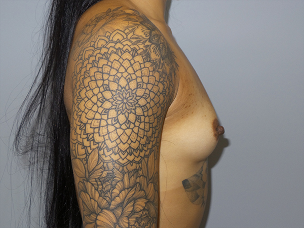 Breast Augmentation Before and After 01 | Grover Aesthetics