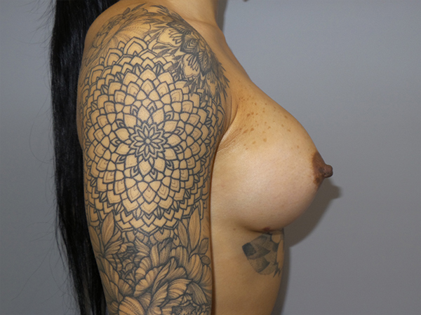 Breast Augmentation Before and After 01 | Grover Aesthetics