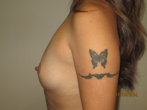 Breast Augmentation Before and After 06 | Grover Aesthetics