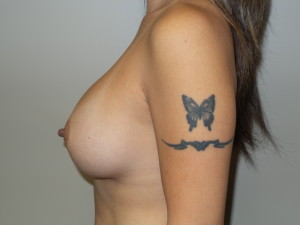 Breast Augmentation Before and After 06 | Grover Aesthetics