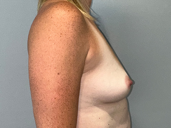 Breast Augmentation Before and After 07 | Grover Aesthetics
