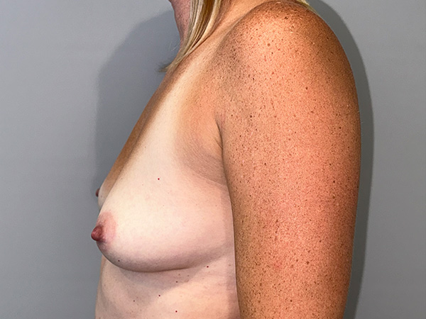 Breast Augmentation Before and After 07 | Grover Aesthetics