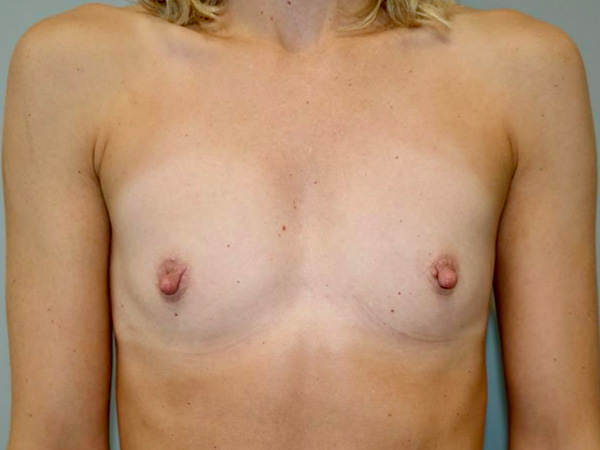 Breast Augmentation Before and After | Grover Aesthetics