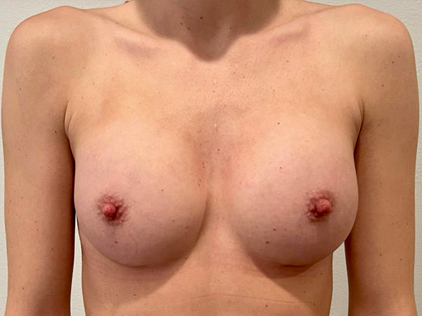 Breast Augmentation Before and After | Grover Aesthetics