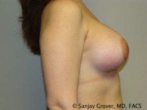 Breast Augmentation Before and After 100 | Grover Aesthetics
