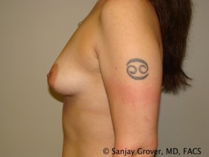 Breast Augmentation Before and After 100 | Grover Aesthetics