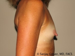 Breast Augmentation Before and After 101 | Grover Aesthetics