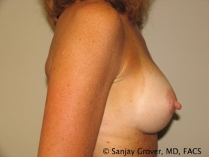 Breast Augmentation Before and After 101 | Grover Aesthetics