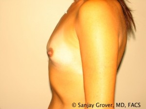 Breast Augmentation Before and After 101 | Sanjay Grover MD FACS