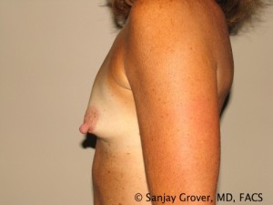 Breast Augmentation Before and After 101 | Grover Aesthetics