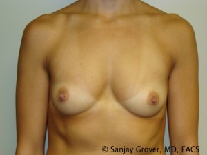 Breast Augmentation Before and After 192 | Sanjay Grover MD FACS