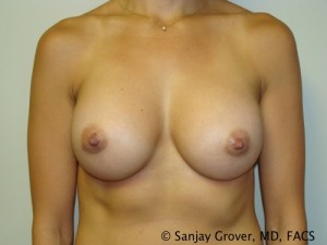 Breast Augmentation Before and After | Grover Aesthetics