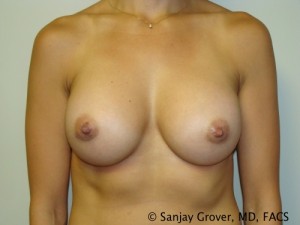 Breast Augmentation Before and After | Sanjay Grover MD FACS