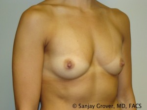 Breast Augmentation Before and After 102 | Grover Aesthetics