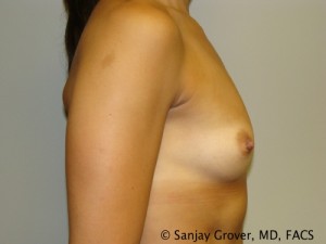 Breast Augmentation Before and After 102 | Grover Aesthetics