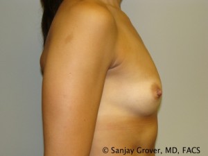 Breast Augmentation Before and After 102 | Sanjay Grover MD FACS