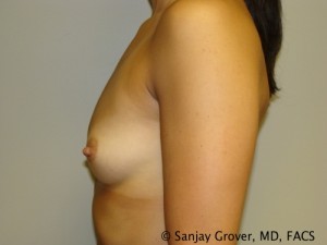 Breast Augmentation Before and After 102 | Grover Aesthetics
