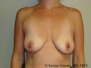 Breast Augmentation Before and After | Grover Aesthetics