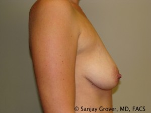 Breast Augmentation Before and After 103 | Grover Aesthetics