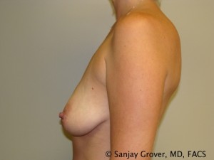 Breast Augmentation Before and After 103 | Grover Aesthetics