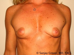 Breast Augmentation Before and After 03 | Sanjay Grover MD FACS
