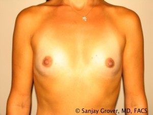 Breast Augmentation Before and After | Grover Aesthetics