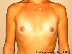 Breast Augmentation Before and After 118 | Sanjay Grover MD FACS