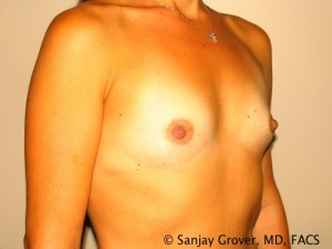 Breast Augmentation Before and After 104 | Grover Aesthetics