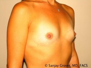 Breast Augmentation Before and After 104 | Sanjay Grover MD FACS