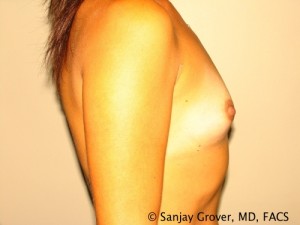 Breast Augmentation Before and After 104 | Grover Aesthetics
