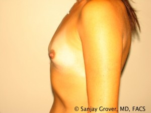 Breast Augmentation Before and After 104 | Grover Aesthetics