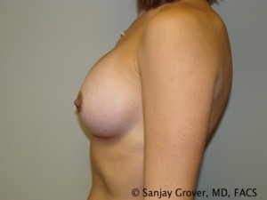 Breast Augmentation Before and After 104 | Grover Aesthetics
