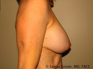 Breast Augmentation Before and After 106 | Grover Aesthetics