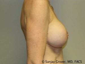 Breast Augmentation Before and After 106 | Grover Aesthetics