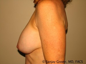 Breast Augmentation Before and After 106 | Grover Aesthetics