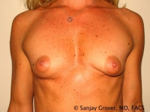 Breast Augmentation Before and After | Grover Aesthetics