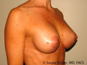 Breast Augmentation Before and After 107 | Grover Aesthetics