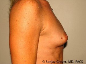 Breast Augmentation Before and After 107 | Grover Aesthetics