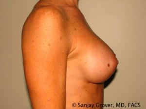 Breast Augmentation Before and After 107 | Grover Aesthetics