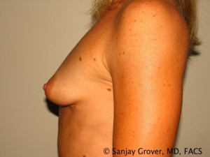 Breast Augmentation Before and After 107 | Grover Aesthetics