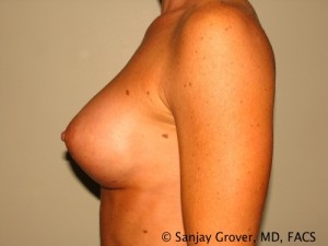 Breast Augmentation Before and After 107 | Grover Aesthetics
