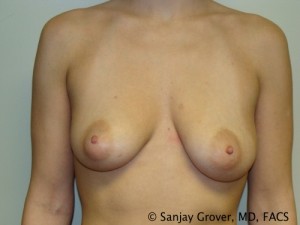 Breast Augmentation Before and After | Grover Aesthetics