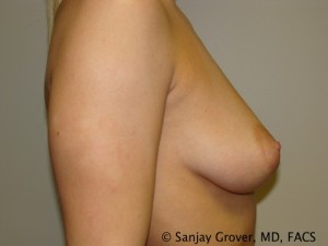 Breast Augmentation Before and After 109 | Grover Aesthetics