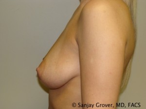 Breast Augmentation Before and After 109 | Grover Aesthetics