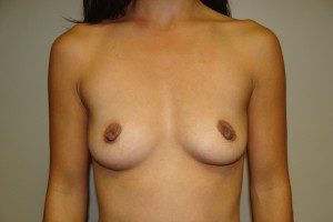 Breast Augmentation Before and After 64 | Sanjay Grover MD FACS
