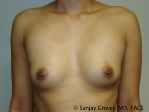 Breast Augmentation Before and After 15 | Sanjay Grover MD FACS