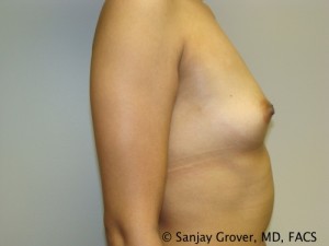 Breast Augmentation Before and After 110 | Sanjay Grover MD FACS