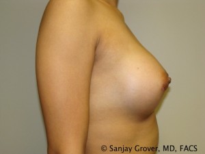 Breast Augmentation Before and After 110 | Grover Aesthetics