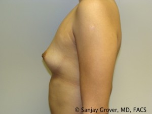 Breast Augmentation Before and After 110 | Sanjay Grover MD FACS